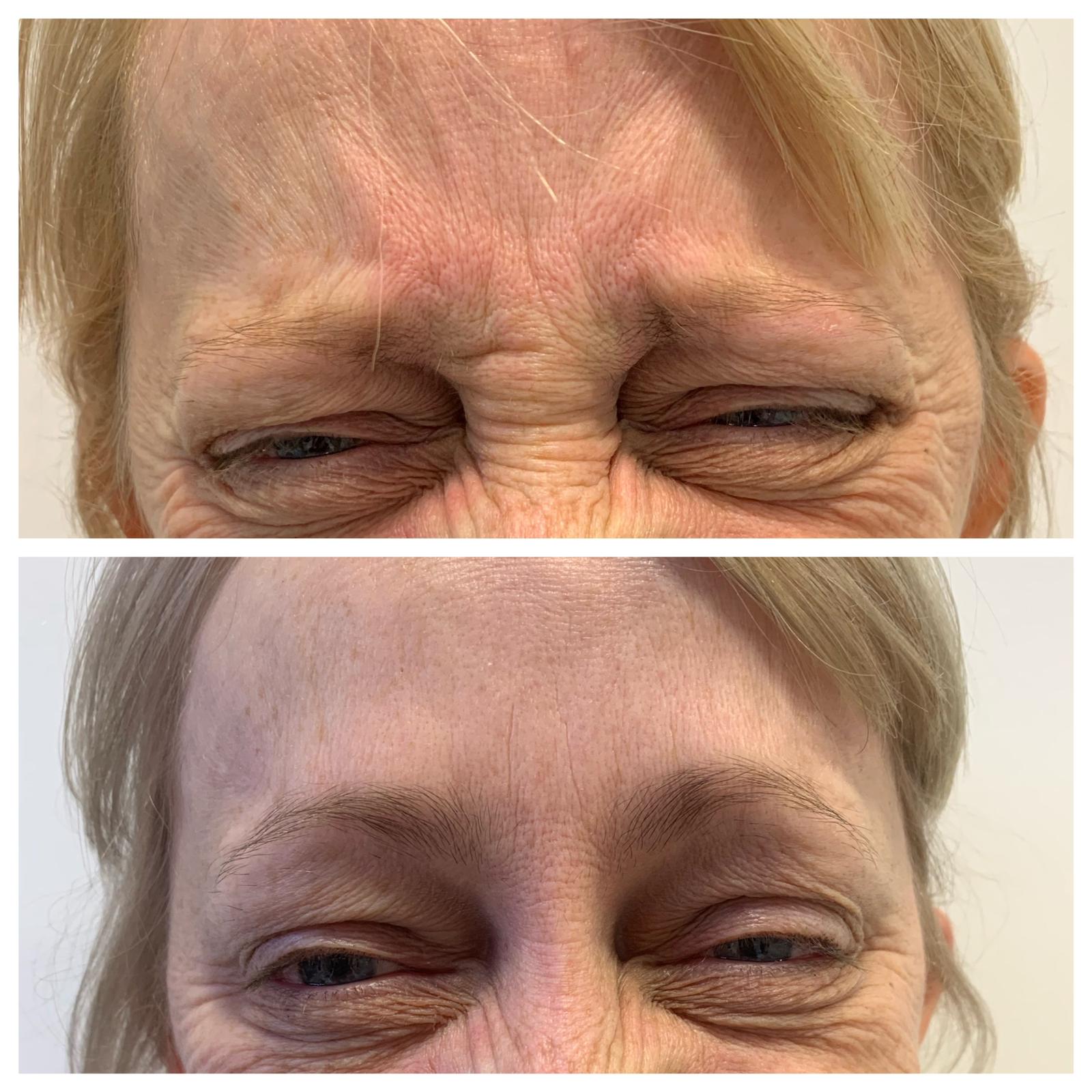 Before and after wrinkle treatment at Evolve