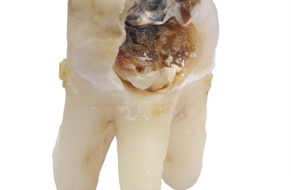 How Do You Know if Your Tooth is Rotten?