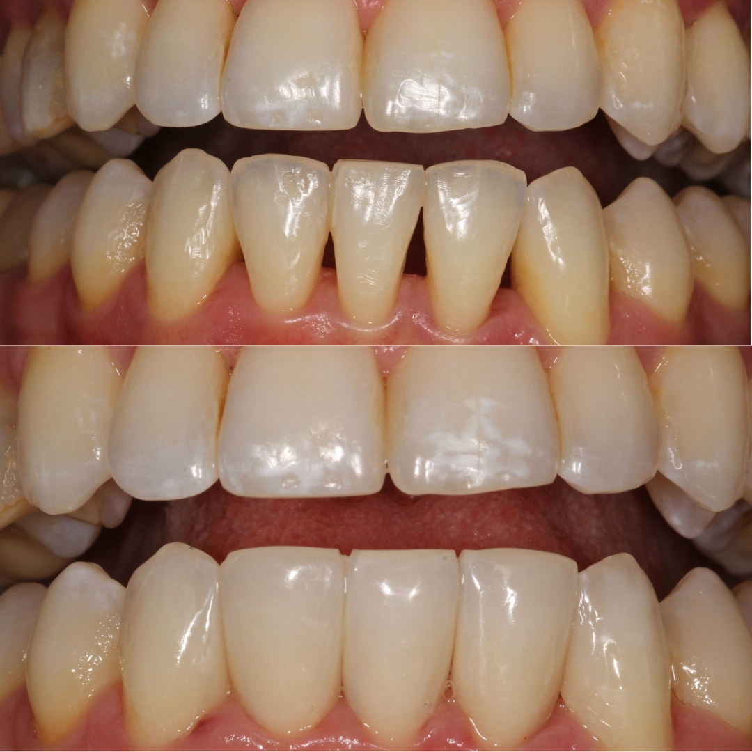 Bonding - Bioclear composite before and after