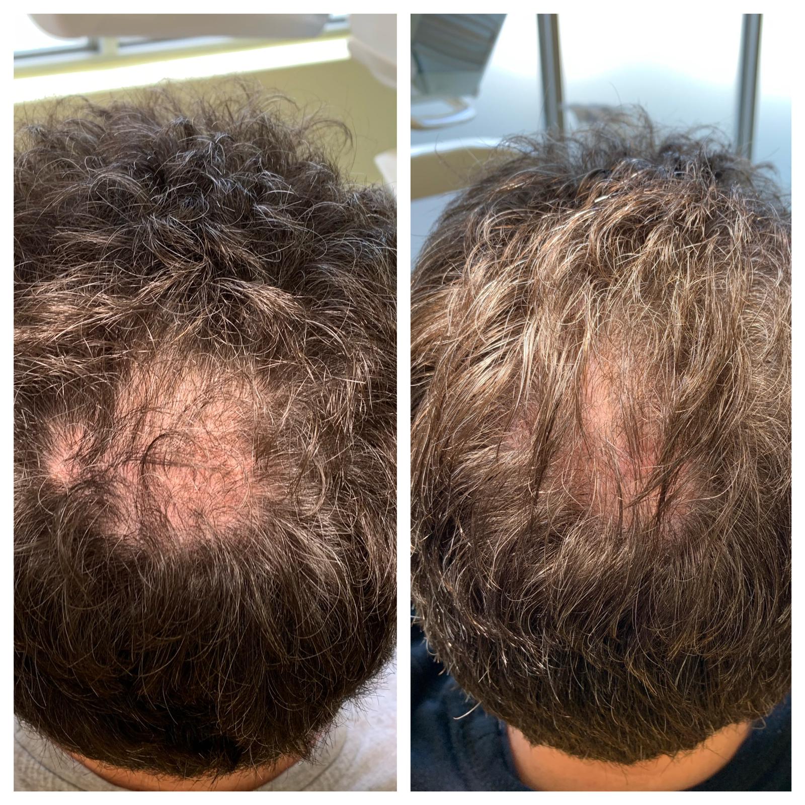 PRP Hair rejuvenation before and after