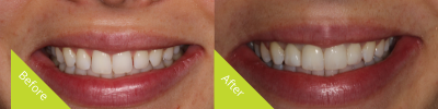 Before and after bioclear