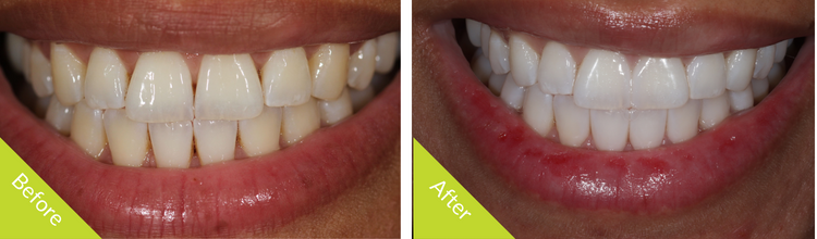 Composite bonding and whitening before and after