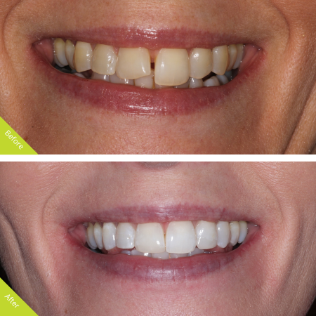 adult teeth straightening portishead